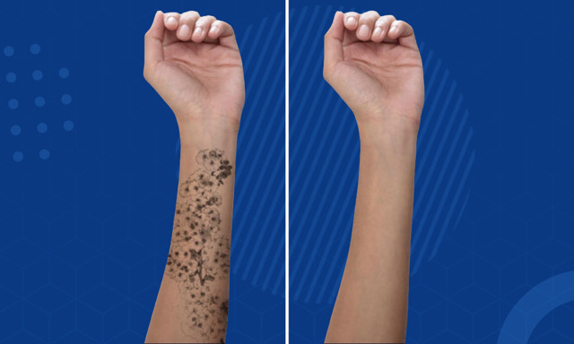 جلسة ازالة التاتو