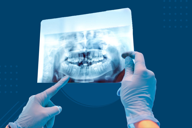 اشعة اسنان جذرية