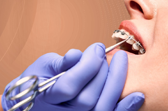 صورة عرض 🦷✨ إزالة التقويم + تنظيف وتلميع الأسنان✨ سيدات ورجال