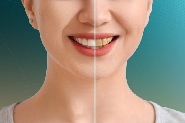 تبييض الأسنان