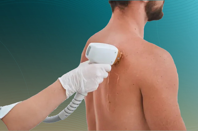 جلسة ليزر رجالي مع البطن و الظهر